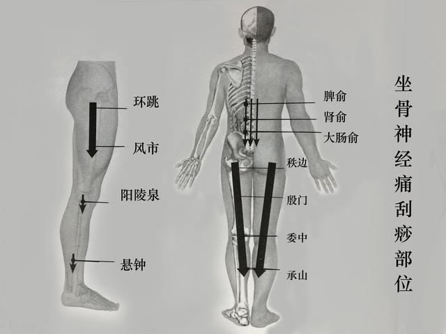 如何预防坐骨神经痛